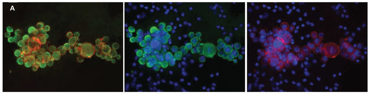 Precision medicine in breast cancer: Data4Cure's platform used in research published in JNCCN